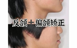 牙齿反颌矫正，脸型真的会变吗？
