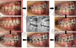 传统正畸磨牙远移的方法有哪些？如何操作？