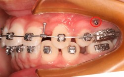 牙齿矫正都要打骨钉吗？
