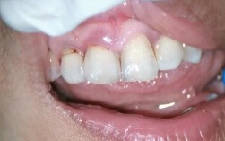 矫正牙齿会导致牙根裸露吗？原因和应对方法是什么？