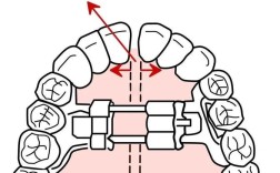 正畸扩弓有哪几种方法？如何选择适合自己的？