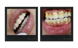 做牙齿矫正后，真的会有后遗症吗？