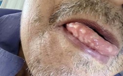 正畸牙齿带环后口腔溃疡频发怎么办？