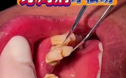 牙周严重到何种程度会让牙医拒绝正畸？背后隐藏着哪些不可忽视的健康风险？