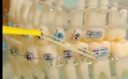 正畸橡皮链不对称为何出现？如何调整不影响矫正效果？