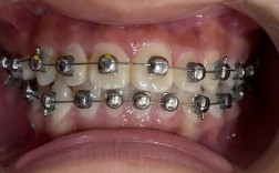 牙齿矫正 新西兰