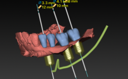 水激光数字化种牙，如何通过精准定位与微创技术，实现种植牙成功率与舒适度的双重突破？