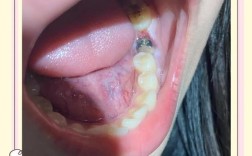 种牙封闭物掉落会引发感染吗？