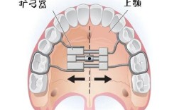 牙齿正畸怎样扩弓