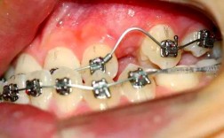 牙齿矫正后天包地