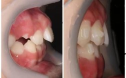 矫正牙齿能改善面容外突的脸型问题吗？
