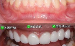 牙贴面和矫正牙齿，哪种更适合牙齿矫正？