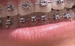 30岁开始正畸，真的有必要吗？时间成本、效果预期和社交影响，该如何权衡？