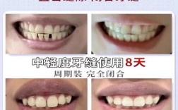 门牙缝隙大如何有效关闭？矫治方法有哪些？