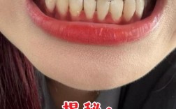 牙齿矫正为何会导致牙龈萎缩？矫正后如何预防？