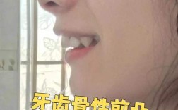 正畸后上牙前突