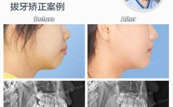 前牙美学正畸治疗，如何兼顾美观与功能达到理想效果？