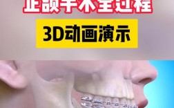 无术前正畸正颌手术