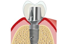 德国贝格种殖牙