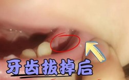 植牙后箍牙，必须拔掉种植牙吗？