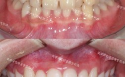 下前牙散在间隙正畸如何矫正？效果能保持多久？