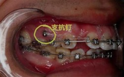 正畸拔牙排开牙齿