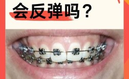 牙齿矫正 深覆合