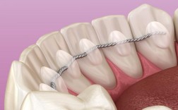 目前松牙固定术哪种方法最好？如何科学选择？