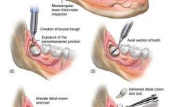 拔牙的基本步骤和操作方法是怎样的？