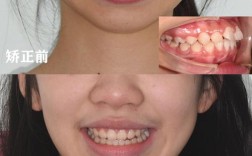 龅牙正颌手术前为何必须进行术前正畸？其具体作用、时长及对手术效果和术后恢复的关键影响是什么？