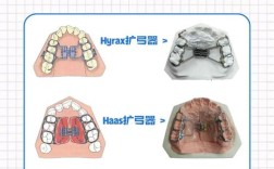 正畸弓形5的形状具体是什么样的呢？