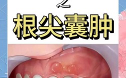 根尖囊肿有哪些有效治疗方法？