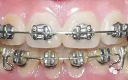 正畸结扎丝怎么拆才正确？自己操作要注意哪些细节？