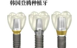 诺贝尔种牙多少钱