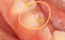 正畸尖牙牙根外凸