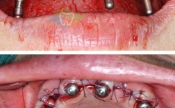 正畸种植钉掉了一点需要处理吗？