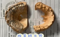 正畸反颌推簧的制作图