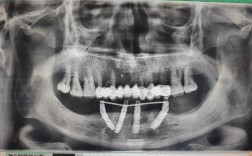 allon4种植牙需要满足哪些条件？