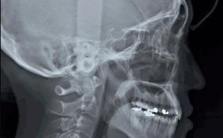 头颅侧位片正畸怎么拍