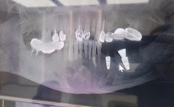 种植牙术前骨量评估为何依赖CT测量？精准数据如何保障种植成功？