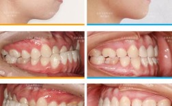 牙齿正畸与脸廓变形