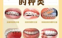 有蛀牙能直接做牙齿矫正吗？需先补牙吗？