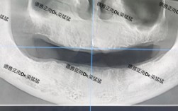 德国种植牙的技术和材料质量到底怎么样？使用寿命、术后效果有哪些优势，价格是否值得选择？