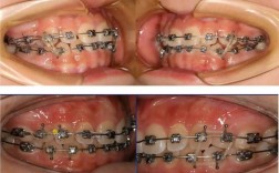 正畸早期轻力牵引有何独特矫正优势？