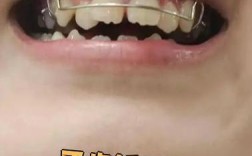 二十二岁矫正牙齿还来得及吗？