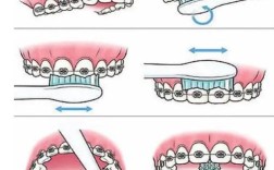 牙齿矫正期间能刷牙吗