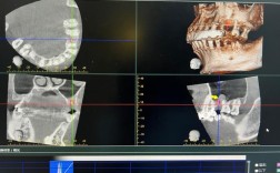 种牙植体穿过上鼻窦