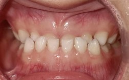 矫正牙齿只整上排？效果和美观能兼顾吗？