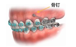 正畸取钉何时最合适？取钉过程会疼吗？
