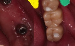 种牙后牙床没感觉，是手术影响还是恢复异常？